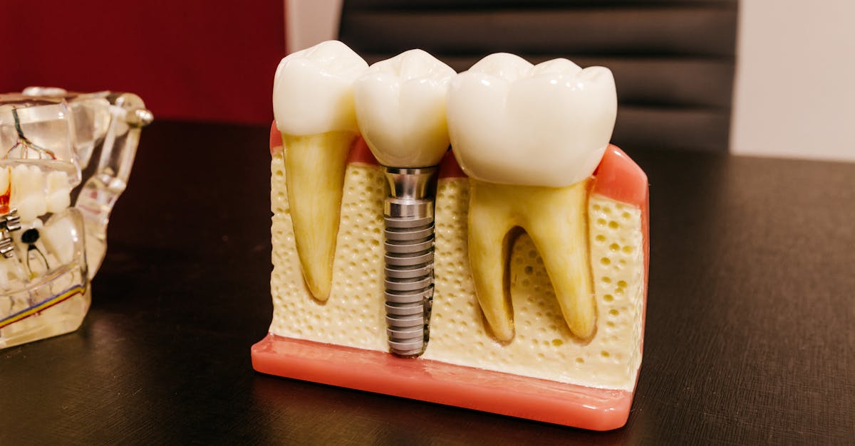 Discounts and Promotions for Dental Implants in Turkey  