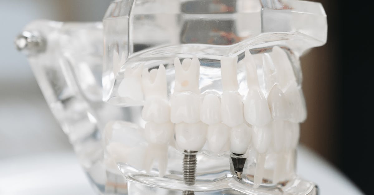 Improved Speech Clarity with Dental Implants in Turkey  