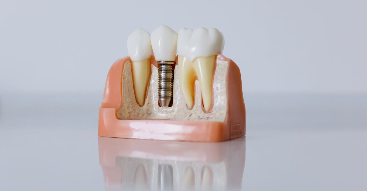 The Functionality of Dental Implants Compared to Other Options in Turkey  