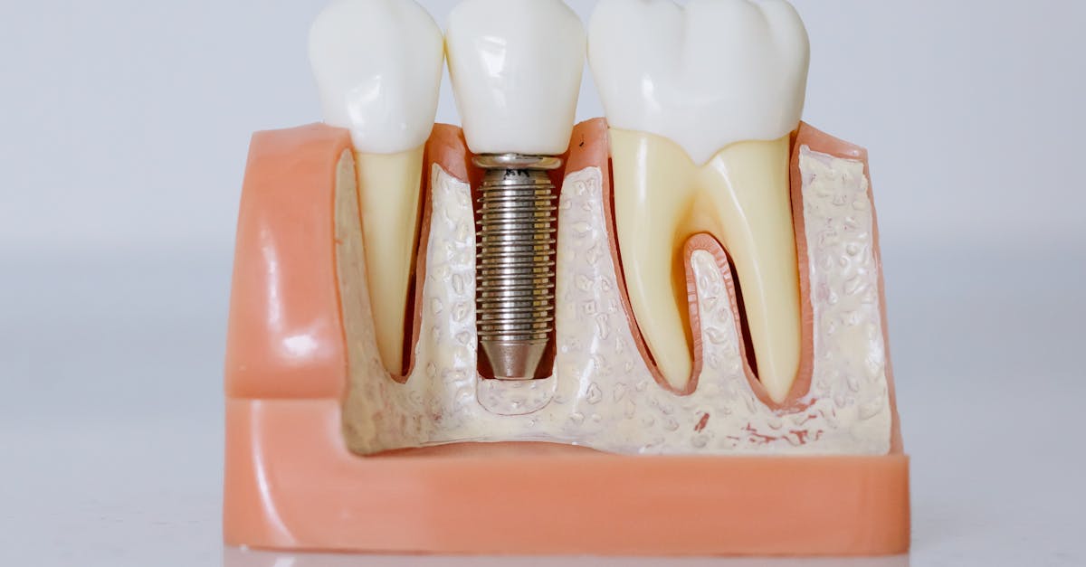 Ease of Eating and Chewing with Implants  