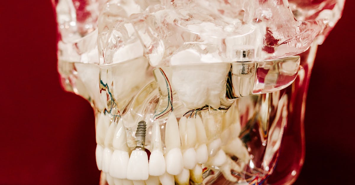 Reducing the Risk of Gum Disease with Implants  